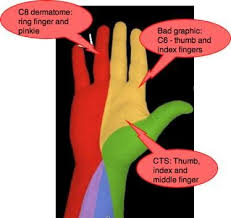 C8 Dermatome Ok This All Started After I Got Whiplash From My Trunk Crashing Down On My Head Now I Have Tingling And Ring Finger Numbness In Fingers Finger