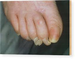 Image result for Onychogryphosis feet