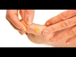 Calos Nos Pés Olho De Peixe Minha Mae Ensina Acabe Com Calos Nos Pes Olho De Peixe Que Susto Youtube Pedicure At Home Home Remedies Listerine Feet