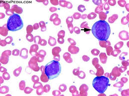 Pathology E Atlas Hematology Medical Laboratory Scientist Medical Laboratory Science