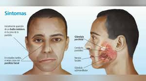 Image result for Sialoadenitis