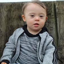 Down's syndrome ds mosaic down syndrome translocation down syndrome trisomy 21. Save Down Syndrome