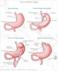 Pin By Connie Chi On Medical Anatomy Illustration Bariatric Surgery Lap Band Surgery Bariatric