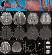 Child Neurology Sjogren Larsson Syndrome Neurology