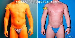 173800) is a disorder in which affected individuals are born with missing or underdeveloped muscles on one side of the body, resulting in abnormalities that can affect the chest. Poland Syndrome Photos Plastic Surgery New York Ny