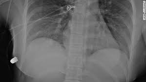 C $68.30 to c $269.82. Woman S Breast Implant Deflects Bullet Saving Her Life Cnn