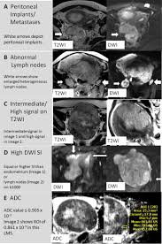 Image result for Leiomyosarcoma