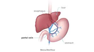 Blood carried by arteries is usually highly oxygenated, having just left the lungs on its way to. Portal Hypertension Symptoms Causes And Treatment
