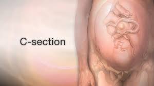 Going Home After A C Section Information Mount Sinai New York