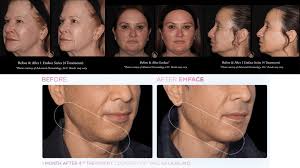 EMFACE Before and After: Achieve a Youthful Lift