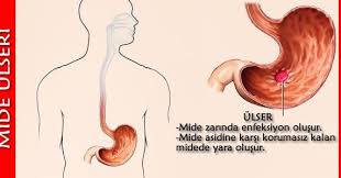 ulser ulser belirtileri sirt agrisi gastrik ulser mide ulserine iyi gelen bitkiler ulser bitkisel tedavi peptik ulse dogal tedaviler dogal dogal receteler