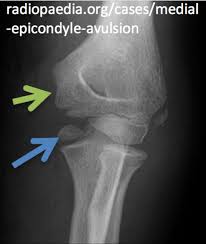 An avulsion fracture usually only needs the treatment of resting and icing the fracture followed by. Interpreting Elbow And Forearm Radiographs Taming The Sru