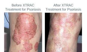 Image result for psoriasis