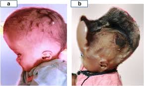 Image result for Hydrocephalus