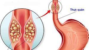 Check spelling or type a new query. Kanser Esofagus Tanda Awal Tersedak Dan Muntah Terlampau Kerap Diet Diet Sihat