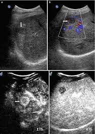 Check spelling or type a new query. Diagnostic Value Of Ultrasound In Metastatic Liver Cancer Springerlink