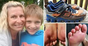 Boy, 9, horrifically burnt after light-up shoes leak acid over his feet