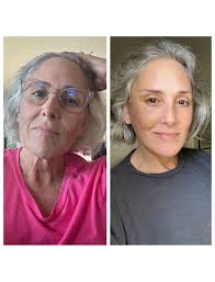 One year ago today I did a thing. Yes, today July 18th, is the one year  anniversary of my deep plane lower face and neck lift, plus a mild co2  laser. I