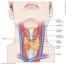 This can make you to feel as if you have something stuck in your throat or chest and can lead to coughing fits or choking when you try to swallow. Thyroid Cancer Stages Cancer Net