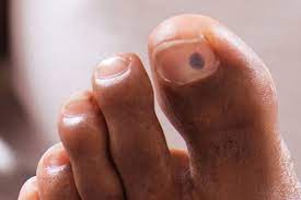 Check spelling or type a new query. Pictures Of Toenail Colors And What They Mean