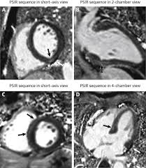 About 25% of all patients with dilated cardiomyopathy have atypical chest pain. Cardiac Involvement In Patients Recovered From Covid 2019 Identified Using Magnetic Resonance Imaging Sciencedirect