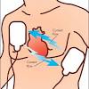 Defibrillator that stops abnormal rapid beating of the heart, and returns it to. 1