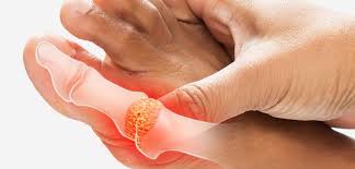 Image result for gout