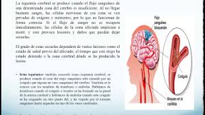 Se denomina isquemia cerebral, cuando el flujo sanguineo es insuficiente para irrigar el cerebro o parte de él y va a dar como consecuencia que una parte del cerebro. Isquemia Cerebral Youtube