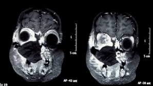 Los síntomas no son específicos y en el período inicial de la enfermedad son similares a los descritos en la aspergilosis. Https Www Researchgate Net Publication 282582513 Tratamiento Exitoso De Una Mucormicosis Rinocerebral Persistente En Un Paciente Pediatrico Durante El Debut De Una Leucemia Aguda Fulltext 5686cdc008aebccc4e13c8ab Tratamiento Exitoso De Una Mucormicosis Rinocerebral Persistente En Un Paciente Pediatrico Durante El Debut De Una Leucemia Aguda Pdf
