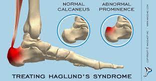 The authors describe a new method of radiologic measurement of haglund's deformity, based on a radiologic study of 31 feet operated. How To Treat Haglund S Syndrome Mass4d Foot Orthotics