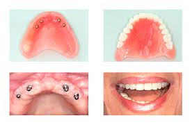 Protese Fixa Ou Implante Dentario Qual E A Melhor Opcao Dentista Tijuca Copacabana Clinica Odontologica Rj