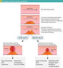 Myocardial infarction (heart attack) — stemi vs. Nstemi Non St Elevation Myocardial Infarction Unstable Angina Diagnosis Criteria Ecg Management Ecg Echo