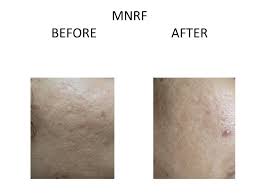 Fortunately, if you do have significant amounts of acne scars on your face, you can actually get some of these fixed fairly inexpensively. Laser Scar Removal Laser Treatment For Scars Venkat Center For Skin Plastic Surgery
