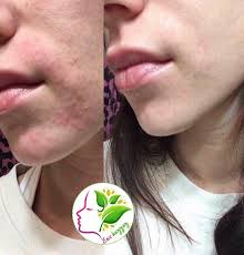 Comment Apaiser Et Soigner Une Peau Allergique Peau Soin De La Peau Nettoyage Visage