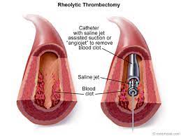 Blood Clot