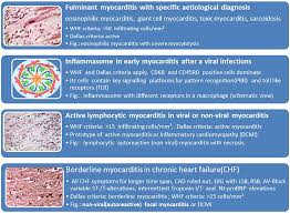 Exactly how many people are affected is hard to know because it often has no symptoms. Frontiers Cardio Immunology Of Myocarditis Focus On Immune Mechanisms And Treatment Options Cardiovascular Medicine