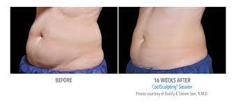 The brilliant distinctions program is a third party rewards program owned and operated by allergan pharmaceuticals. Save 500 On Coolsculpting For A Limited Time