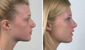 Repulsive Tooth Implant Other Teethwhiteninglongisland Clearchoicedentalimplantscost Teeth Implants Nose Surgery Plastic Surgery