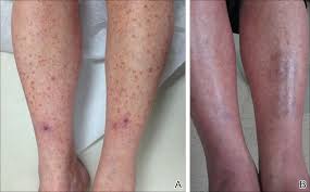 The most noticeable sign is the skin color change. Leukocytoclastic Vasculitis Resolution With Topical Dapsone Mdedge Dermatology