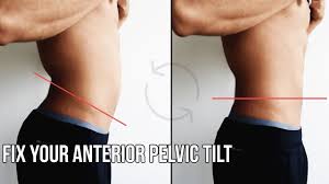 How To Fix Anterior Pelvic Tilt Apt Pelvic Tilt Posture Exercises Posture Correction Exercises