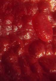 2 symptoms and diagnosis of pericarditis. Tuberculous Pericarditis Intechopen