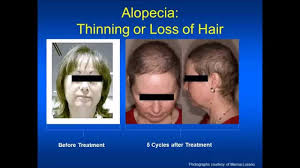 Hair dye is classified into three major groups — temporary, semipermanent, and permanent. Side Effect Management Hair Color Loss Youtube