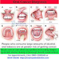 Gum cancer has a good prognosis when detected at an early stage. Pin On Oral Medicine And Radiology