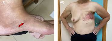 Image result for ant bite