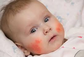 Here are some efficient home remedies for eczema. Eczema In Infants Causes Signs Home Remedies