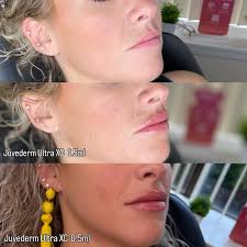 This beautiful woman. 🥰 When she came in for a consultation 6 weeks ago,  she shared her wish to look good and feel good when she turns 50-years-old  (a week after the