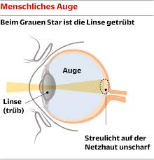 Grauer Star Neue Linsen Fur Den Besseren Durchblick