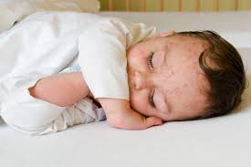 Herpes Baby Symptome Und Effektive Behandlungsmethoden