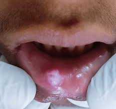 Image result for Labial mucosa