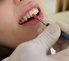 You can multiply the cost per veneer times how many teeth are involved, to show you your. Teeth Whitening Vs Veneers Which One Is Best Dental Health Society